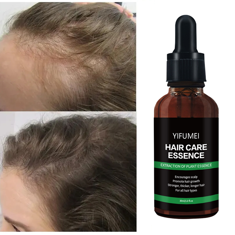 Private Label Ginger Rosemary Hair Regrowth Oil