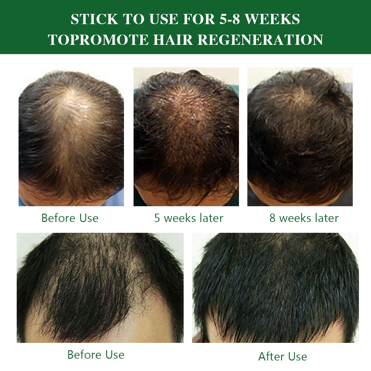 Private Label Ginger Rosemary Hair Regrowth Oil